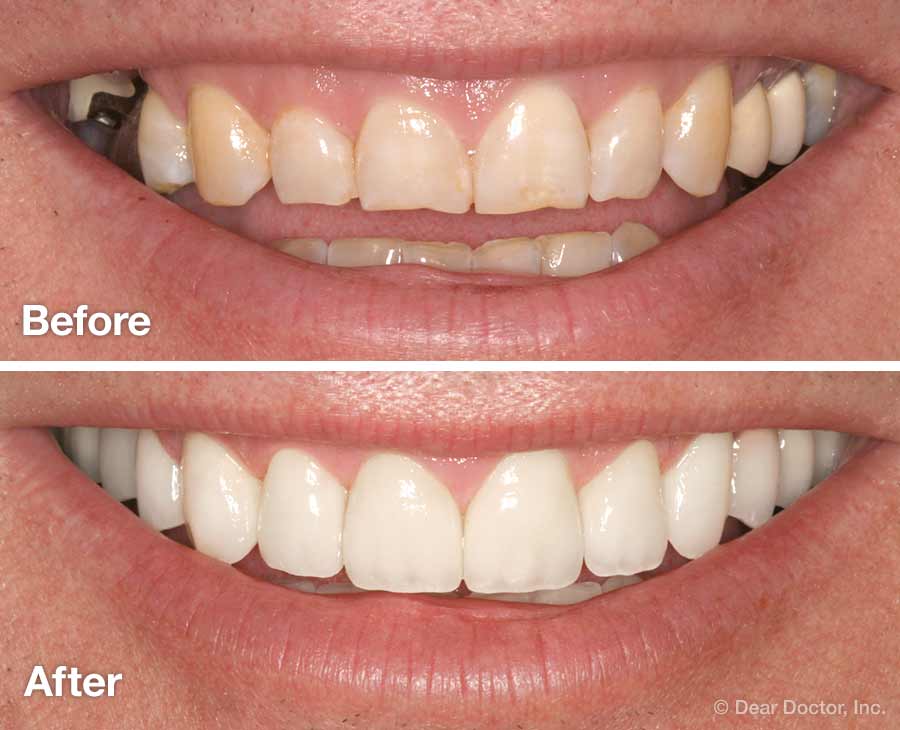 Before full smile makeover