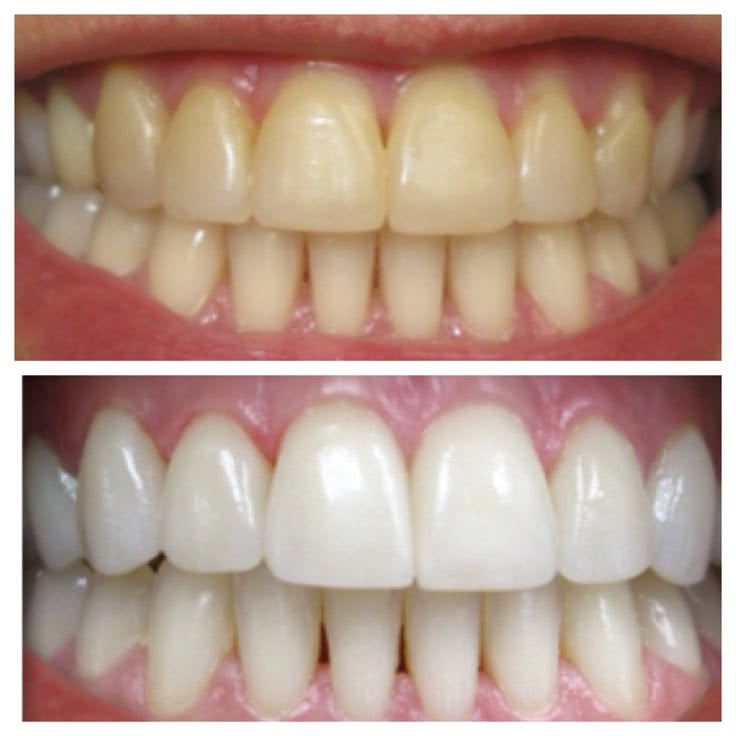 Before teeth whitening