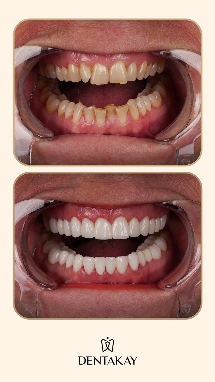 Before porcelain veneers treatment